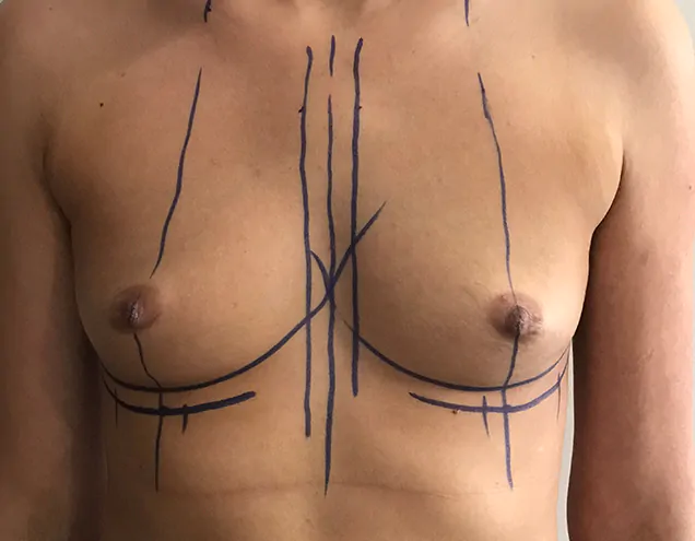 chirurgia plastyczna dr jasek powiększanie piersi 1